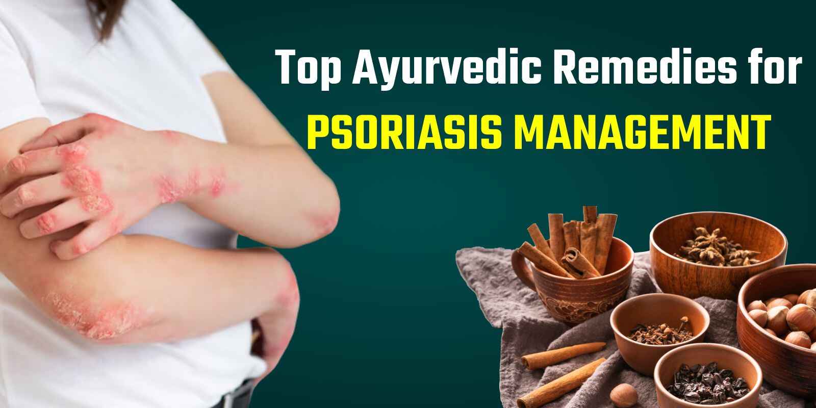 Ayurvedic Remedies for Psoriasis Management